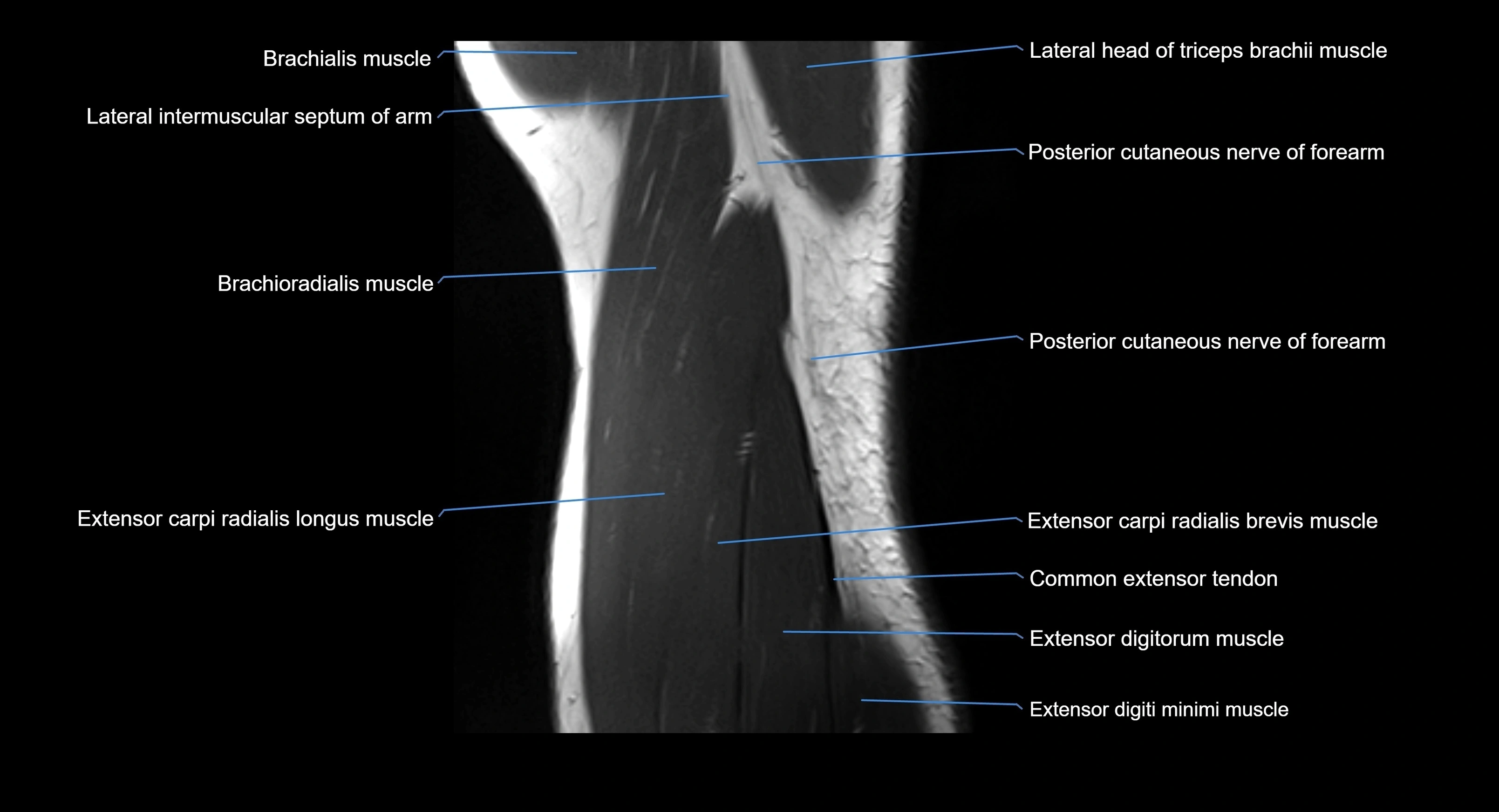 MRI elbow joint  sagittal cross sectional anatomy 3T  radiology  image-img-00001-00022.webp